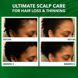 Scalp Oil for Hair Loss & Thinning Hair – Natural Growth Care