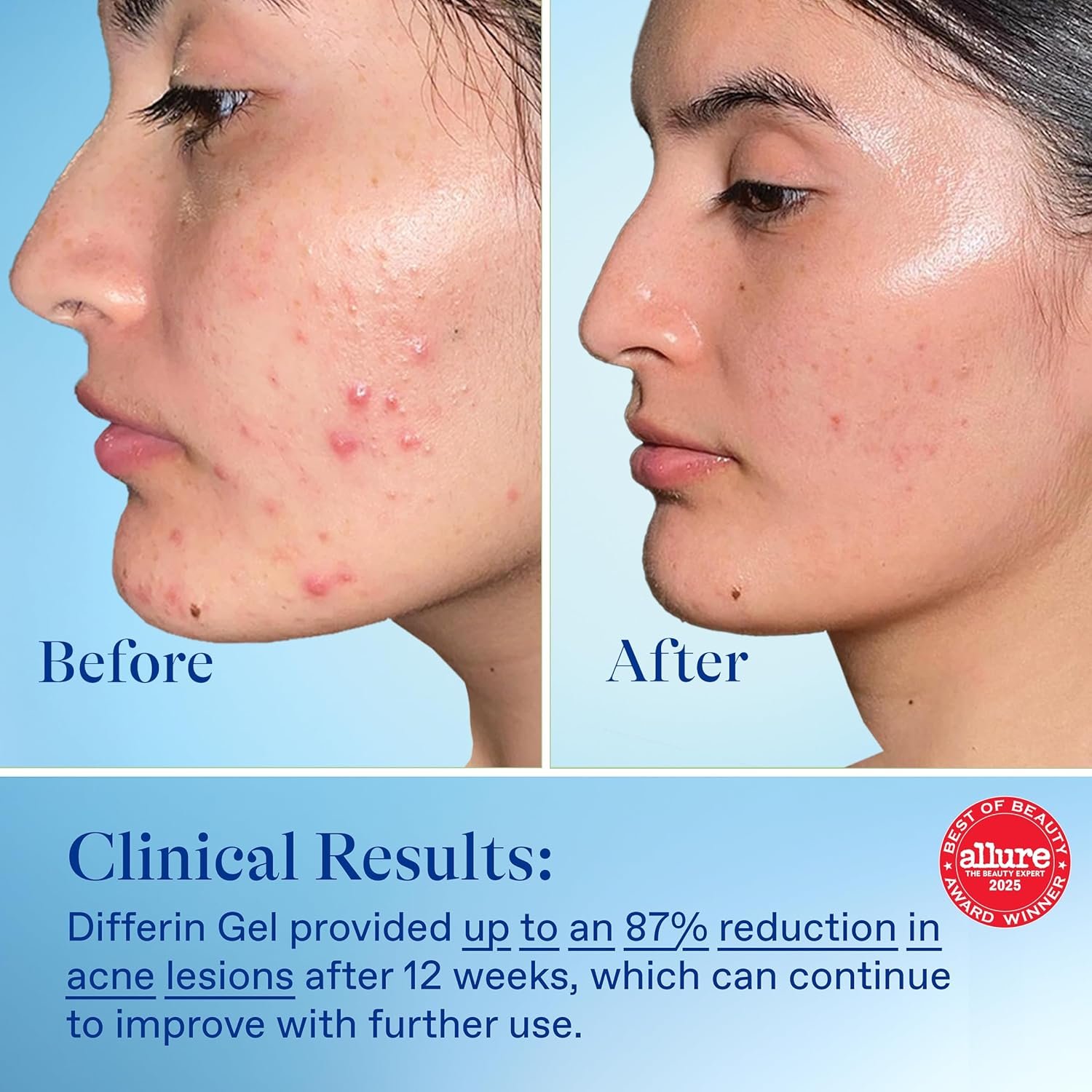 Differin Gel for Sensitive Skin