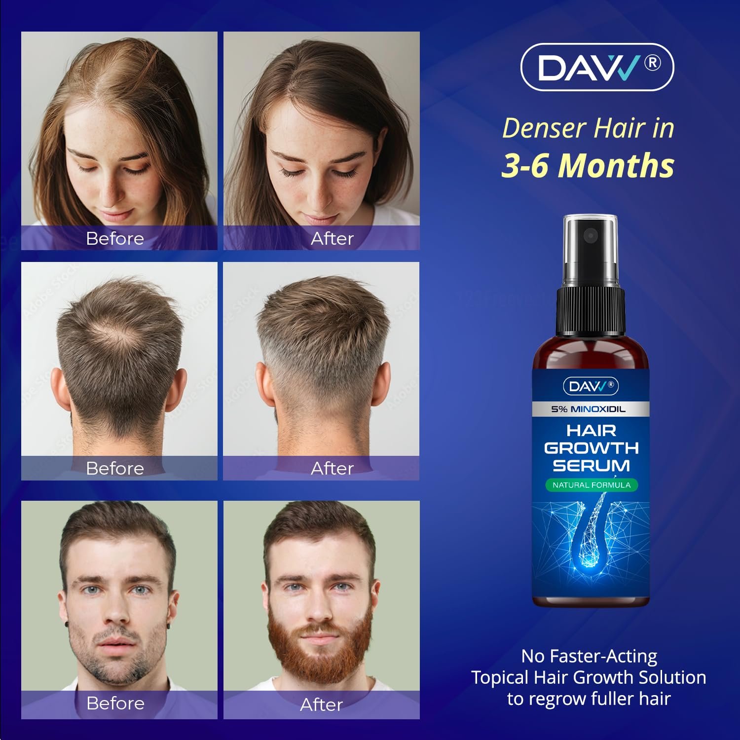 Rosemary Minoxidil Hair Growth Spray Review